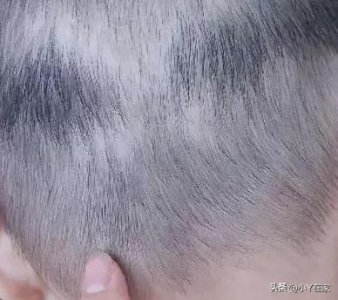 ​惊！宝宝后脑勺有一个会移动的小疙瘩
