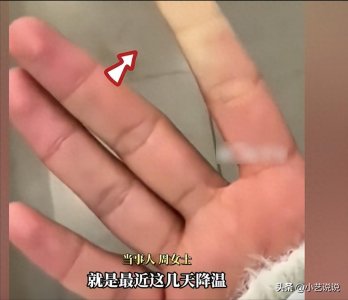 ​你见过因为寒冷 手指冻成白色的样子吗？一个女孩就出现了这种情况