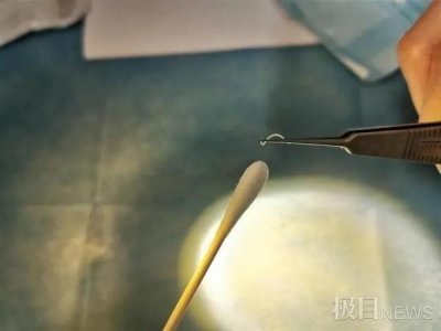​可怕！医生竟从2岁男童眼里捉出6条蠕动活虫，这些坏习惯得戒掉