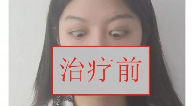 ​甲亢突眼，甲状腺相关眼病治疗前后对照照片