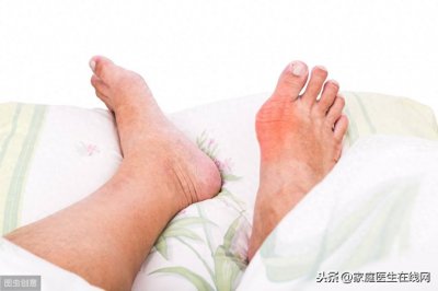 ​这3类食物，嘌呤含量都不低！高尿酸人群遇见了，请自动回避