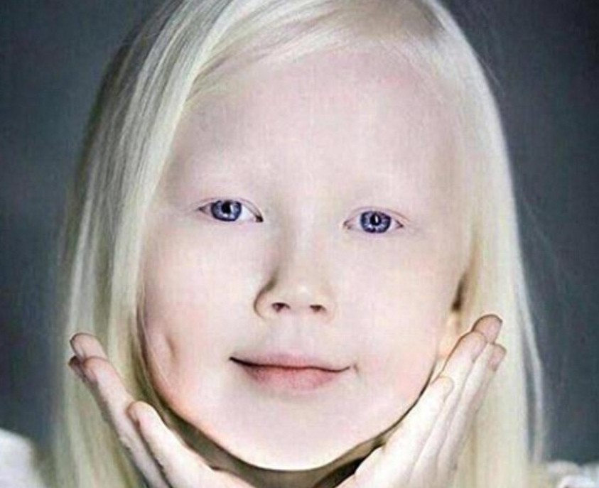 8岁小女孩患白化病,毛发和皮肤呈银白色,被称为“白雪公主”!