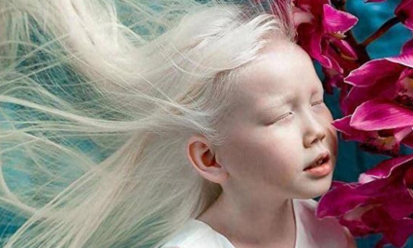 8岁小女孩患白化病,毛发和皮肤呈银白色,被称为“白雪公主”!