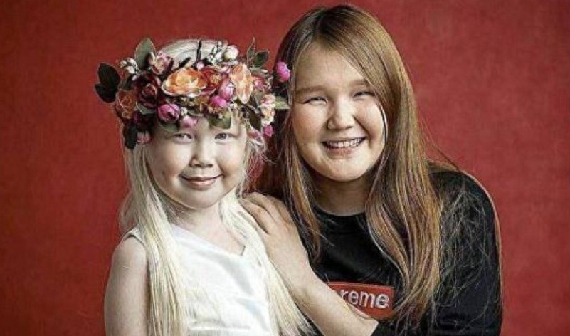 8岁小女孩患白化病,毛发和皮肤呈银白色,被称为“白雪公主”!