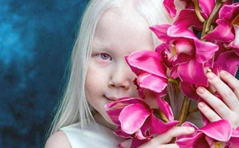 8岁小女孩患白化病,毛发和皮肤呈银白色,被称为“白雪公主”!