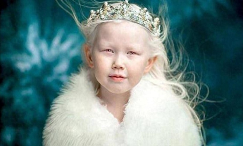 8岁小女孩患白化病,毛发和皮肤呈银白色,被称为“白雪公主”!