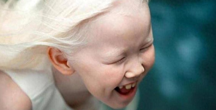 8岁小女孩患白化病,毛发和皮肤呈银白色,被称为“白雪公主”!